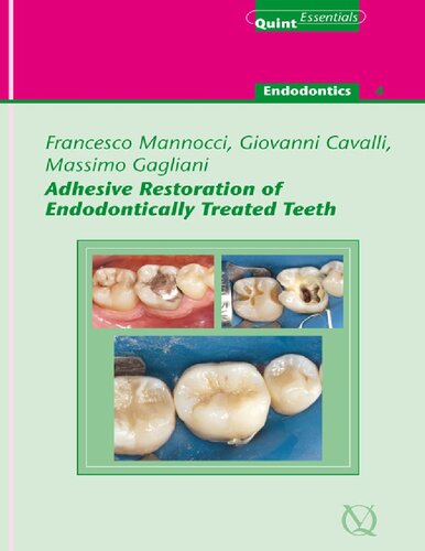 Adhesive Restoration of Endodontically Treated Teeth : QuintEssentials of Dental Practice Vol. 40.