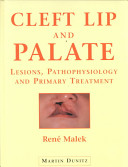 Cleft Lip and Palate