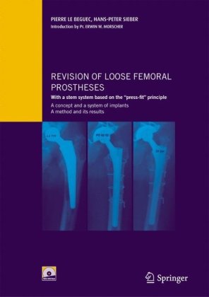 Revision Of Loose Femoral Prostheses With A Stem System Based On The &quot;Press Fit&quot; Principle