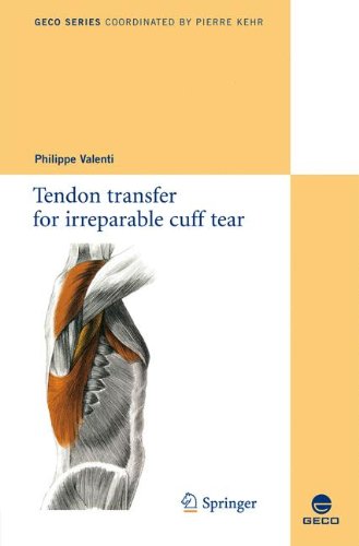 Tendon Transfer for Irreparable Cuff Tear