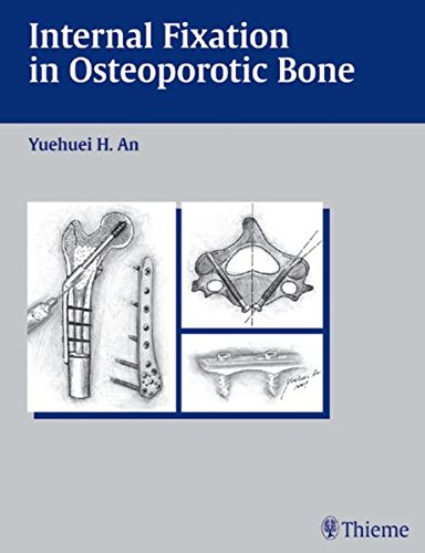 Internal Fixation in Osteoporotic Bone