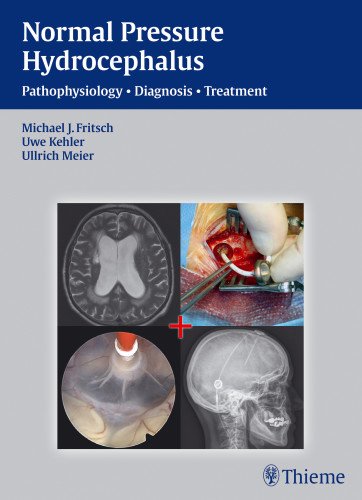 NPH - Normal Pressure Hydrocephalus