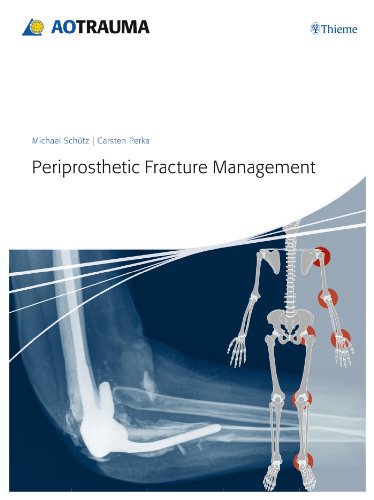 Periprosthetic Fracture Management