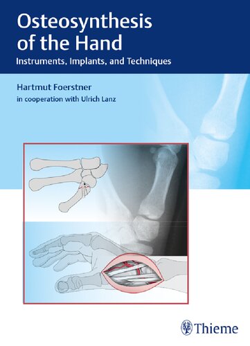 Osteosynthesis of the hand : instruments, implants, and techniques