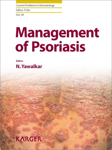 Management of Psoriasis