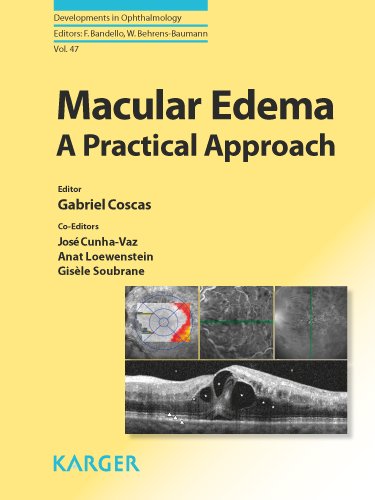 Macular Edema