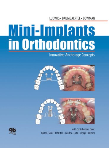 Mini-Implants in Orthodontics