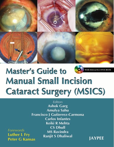 <div class=vernacular lang="en">Masterђ́ةs Guide to Manual Small Incision Cataract Surgery (MSICS)</div>