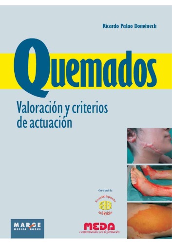 Quemados : valoración y criterios de actuación