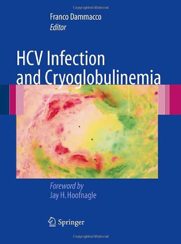 HCV Infection and Cryoglobulinemia