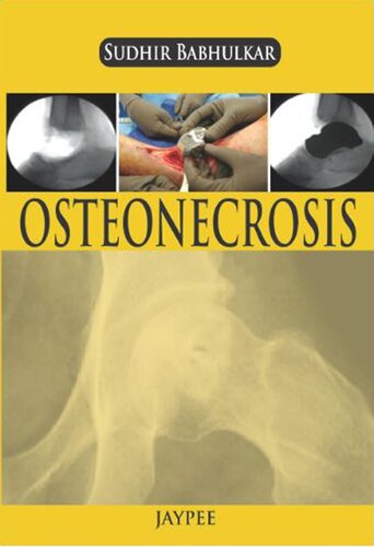 Osteonecrosis