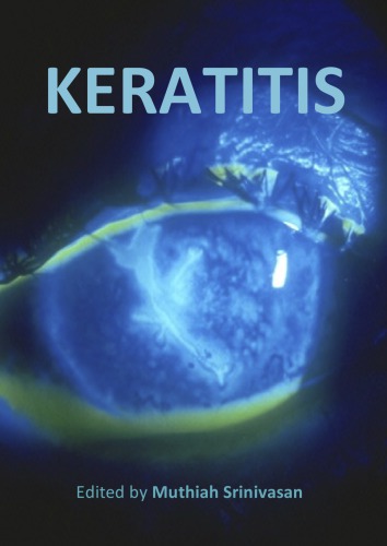 Keratitis Caused By Onchocerciasis Wolbachia Bacteria Play a Key Role