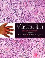 Vasculitis