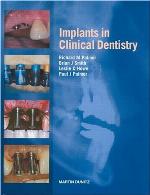 Implants in Clinical Dentistry