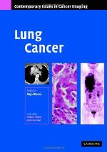 Lung Cancer