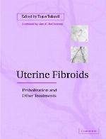 Uterine Fibroids
