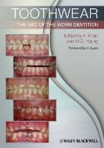 Toothwear : the ABC of the worn dentition