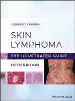 Skin Lymphoma