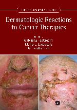 Dermatologic Reactions to Cancer Therapies