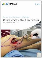 Minimally Invasive Plate Osteosynthesis (Mipo)