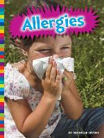 Allergies