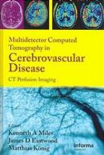 Multidetector Computed Tomography In Cerebrovascular Disease