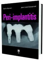 Peri-Implantitis
