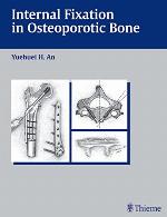 Internal Fixation in Osteoporotic Bone